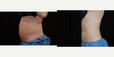 CoolSculpting before and after photo