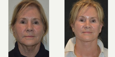 Neck Lift before and after photo