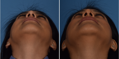 Rhinoplasty before and after photo