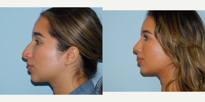 Rhinoplasty before and after photo