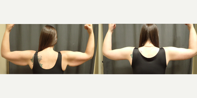 Arm Lift before and after photo