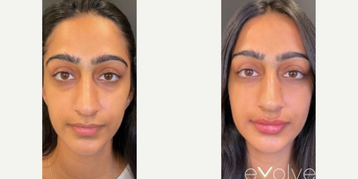 Dermal Fillers before and after photo