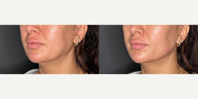 Dermal Fillers before and after photo