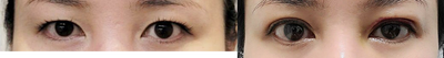 Eyelid Surgery before and after photo