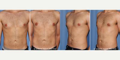 Gynecomastia Surgery before and after photo