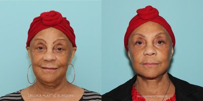 Neck Lift before and after photo