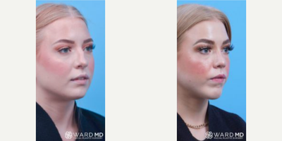 Rhinoplasty before and after photo