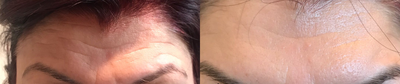 Botox before and after photo