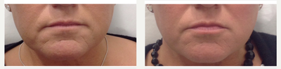 Dermal Fillers before and after photo
