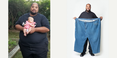 Duodenal Switch before and after photo