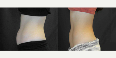 SculpSure before and after photo