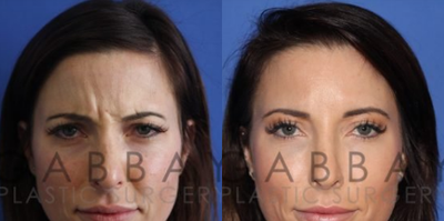 Botox before and after photo