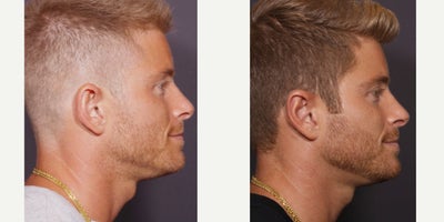 Ear Surgery before and after photo