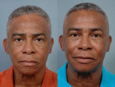 Eyelid Surgery before and after photo