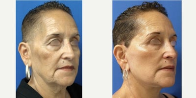 Facial Fat Transfer before and after photo