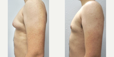 Gynecomastia Surgery before and after photo