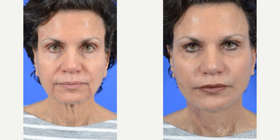 Neck Lift before and after photo