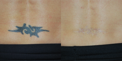 Tattoo Removal before and after photo