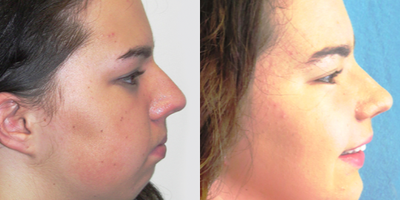Dermal Fillers before and after photo