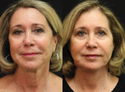 Facelift before and after photo