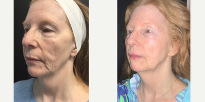 Lip Fillers before and after photo