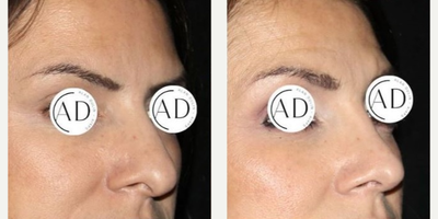 Rhinoplasty before and after photo