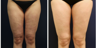 Cellulaze before and after photo