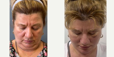 before and after image