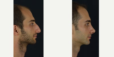 Rhinoplasty before and after photo