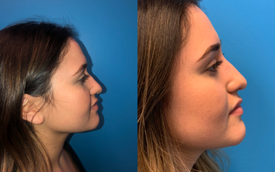 Dermal Fillers before and after photo
