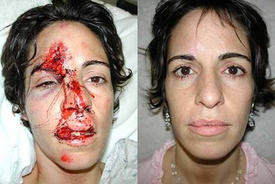 Facial Reconstructive Surgery before and after photo
