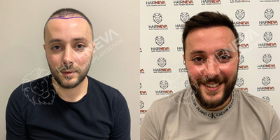 FUE Hair Transplant before and after photo