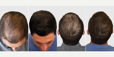 Hair Transplant before and after photo
