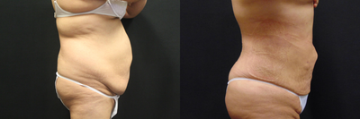 Laser Liposuction before and after photo
