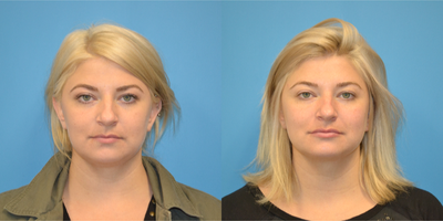 Lip Fillers before and after photo