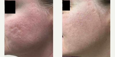 Microneedling before and after photo