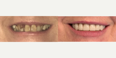 All-on-4 Dental Implants before and after photo