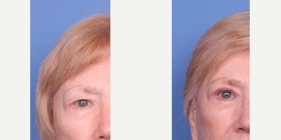 Eyelid Surgery before and after photo