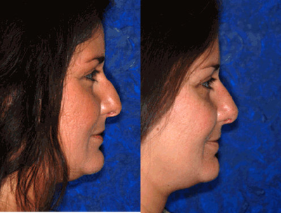 Rhinoplasty before and after photo