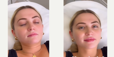Botox before and after photo