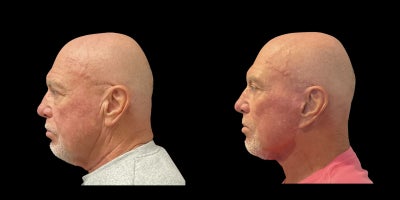 Eyelid Surgery before and after photo