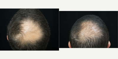 FUE Hair Transplant before and after photo