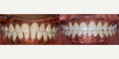 Invisalign before and after photo