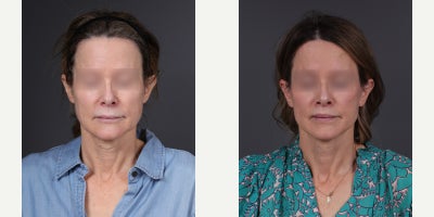 Neck Lift before and after photo