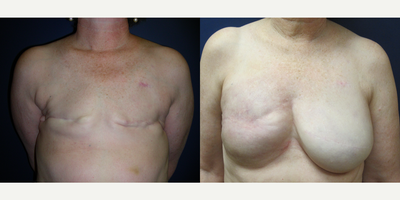 Breast Reconstruction before and after photo