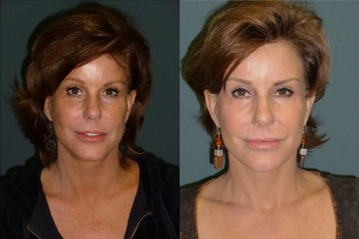 CO2 Laser before and after photo
