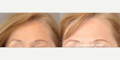 Fraxel Laser before and after photo