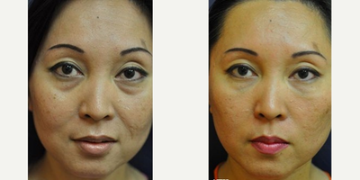 Belotero before and after photo
