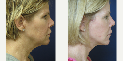 Facelift before and after photo