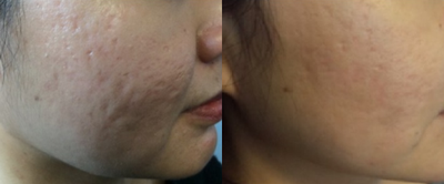 TCA Peel before and after photo